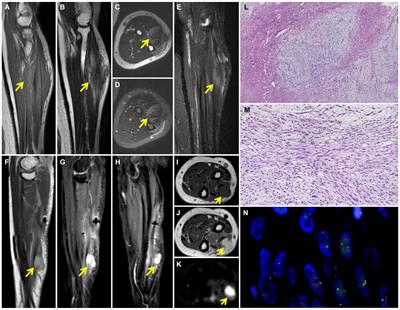 An elderly low-grade fibromyxoid sarcoma patient with early postoperative recurrences and metastases: a case report and literature review